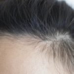 女性のM字ハゲの原因と対策【前髪がハゲてきたら読むべき】