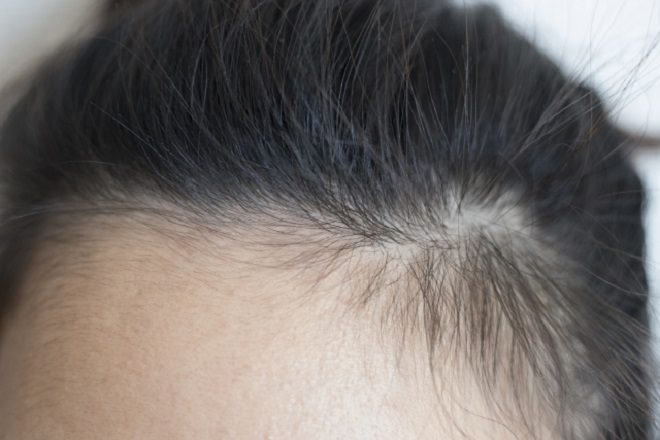 女性のm字ハゲの原因と対策 前髪がハゲてきたら読むべき 薄毛 改善 方法 まとめ